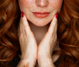 freckles_jennifertoebben freckles_jennifertoebben